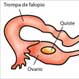 Quistes ováricos: Qué son y cómo detectarlos