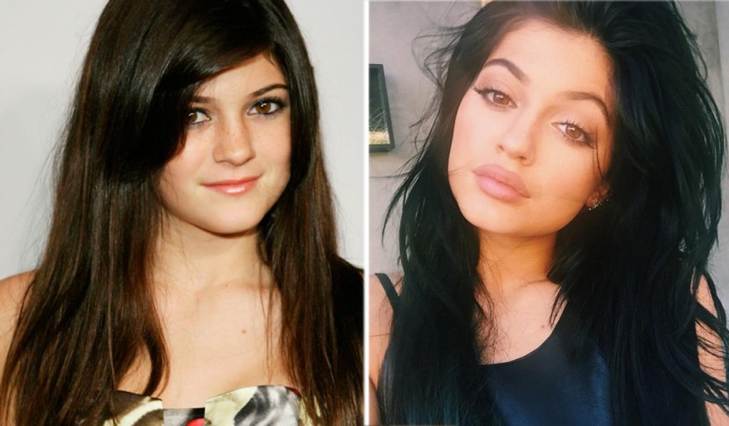 kylie jenner cirugias antes y despues