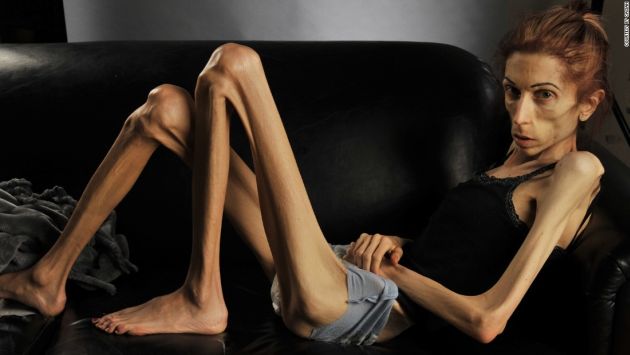 mujer anorexia severa 2