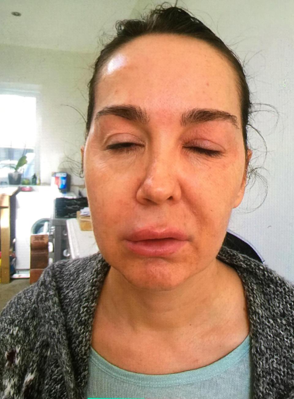 belinda hayle maquilladora botox botulismo 1
