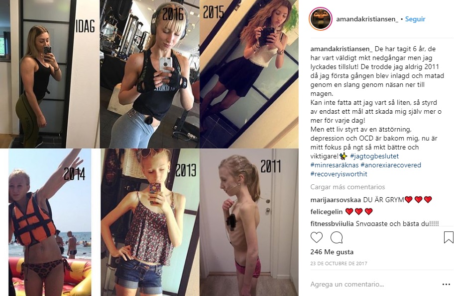 joven que se recupero de la anorexia antes despues
