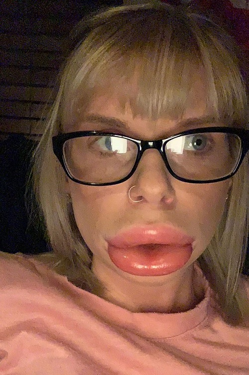 aumentar los labios alergia
