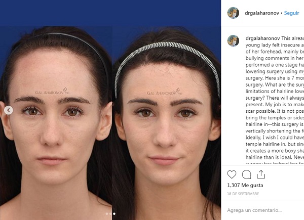 frontoplastia de reducción cirugia antes despues