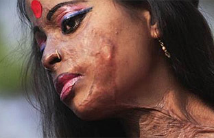 Mujer india quemada con ácido Mujer india quemada con ácido