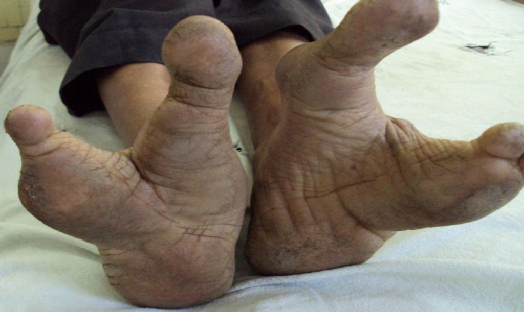 Pies de Avestruz