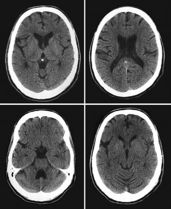 Neurobiólogo recomienda dormir bien y meditar para rejuvenecer el cerebro.