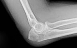 Fracturas de codo: ¿Cuál debe ser el tratamiento para recuperarnos?