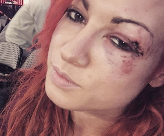 Becly Lynch luego que Nia Jax le fracturara la nariz y el orbital derecho de un puñete