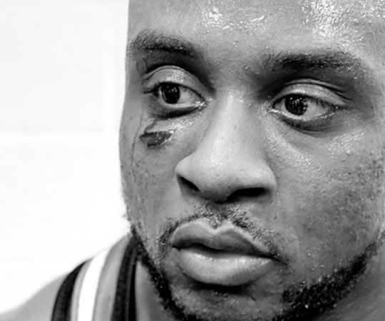 Big E tras recibir 4 puntos en su ojo derecho