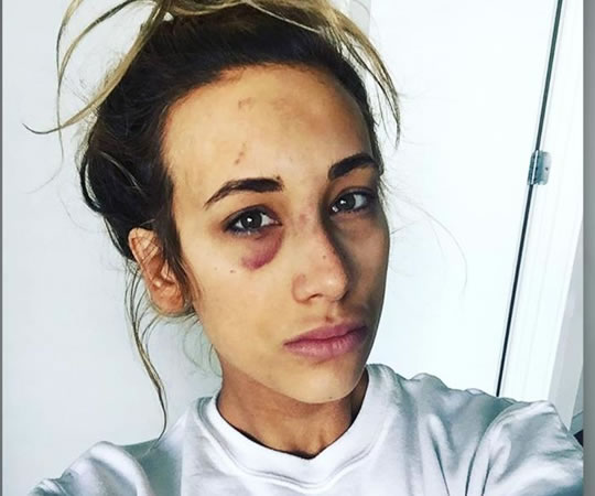 Carmella con su ojo en tinta y boca morada tras luchar contra 5 mujeres en Smackdown!