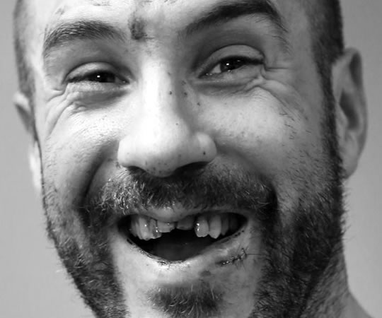 Cesaro luego de perder dos dientes en una lucha