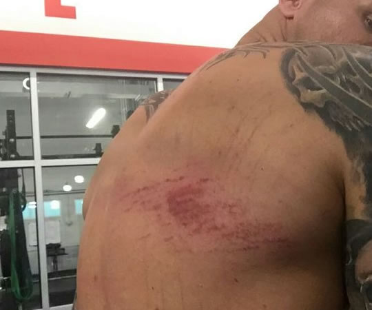 Randy Orton y los moretones que le dejaron en su espalda el atravesar una mesa