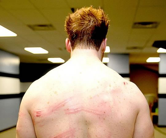 La espalda de Sheamus luego de ser atacado con palos de kendo