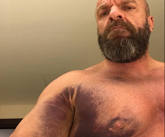 El trriceps de Triple H tras un desgarro en el evento Crown Jewel 2018