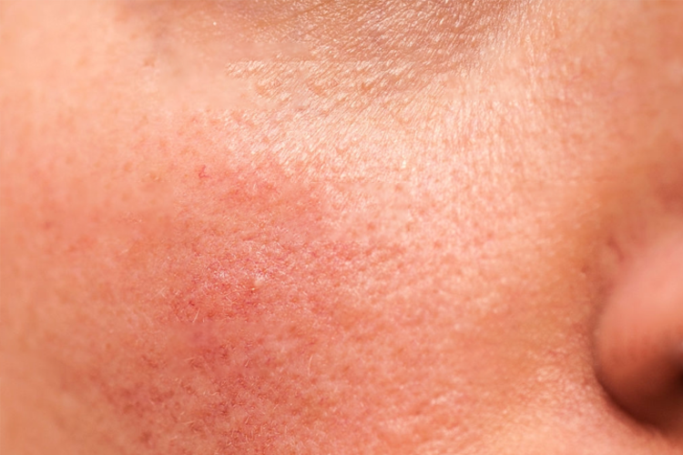 urticaria