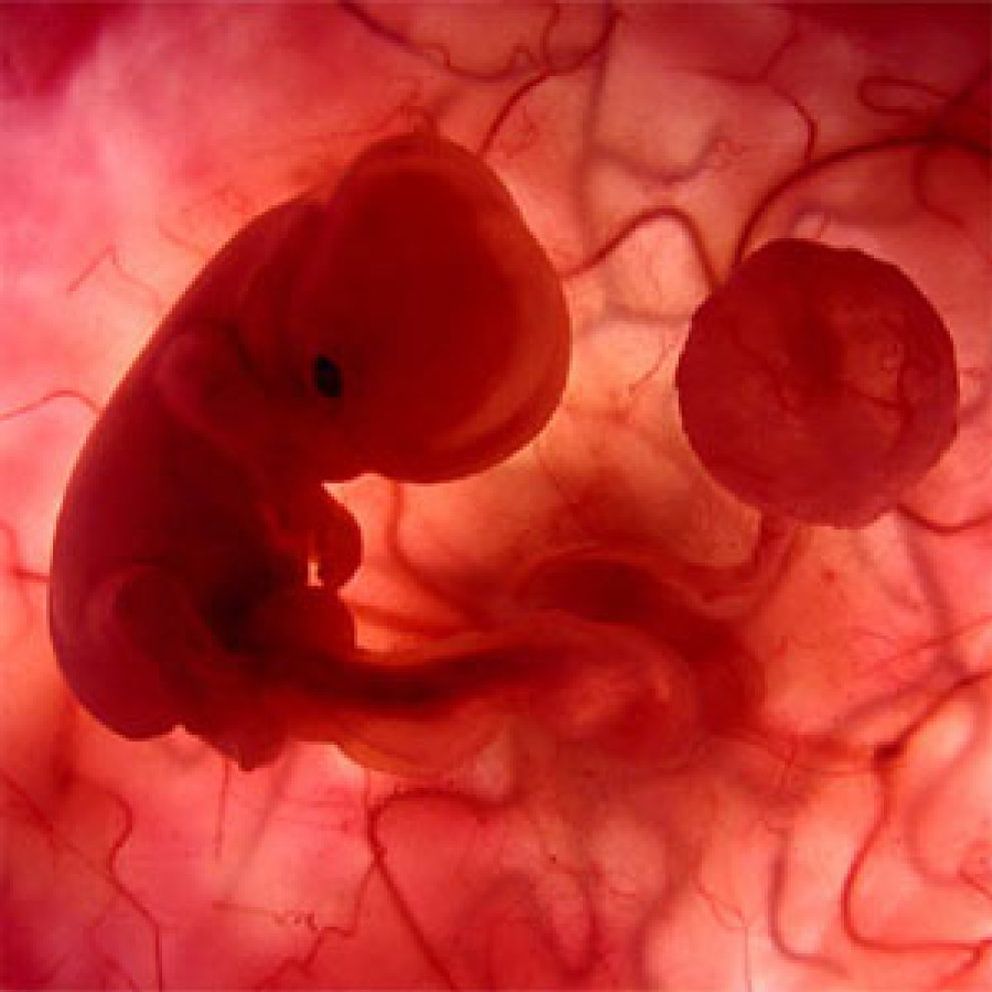 aborto