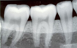 Radiografías dentales en embarazo, lo que hay que saber