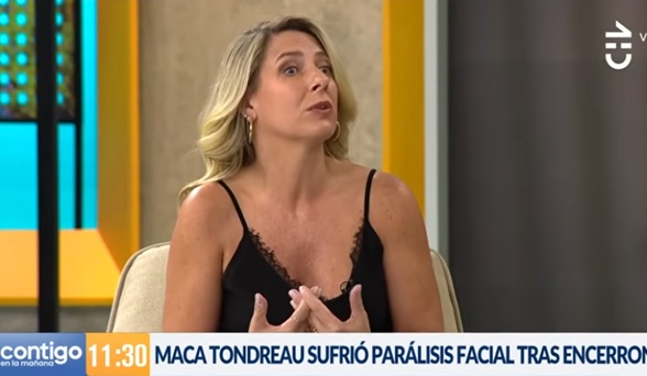 Macarena Tondreau parálisis facial
