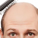 ¿Cómo prevenir la caída del cabello? Consejos para evitar la Alopecia