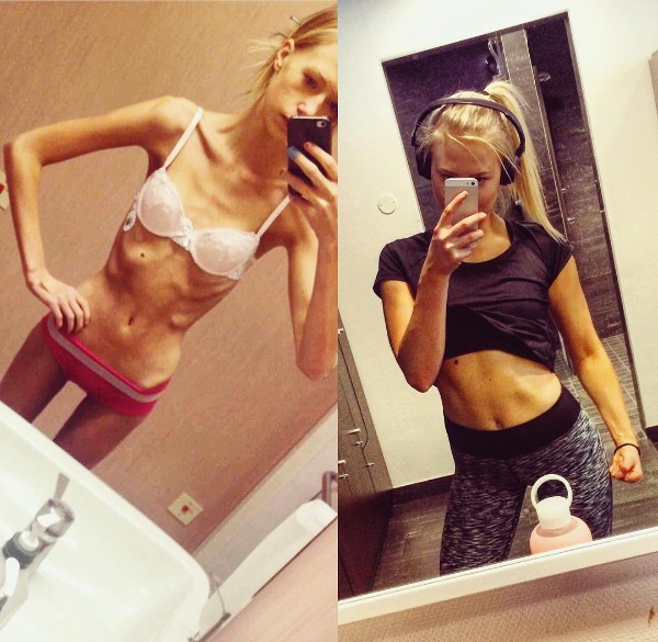 anorexia-recuperacion-antes-despues-fitness