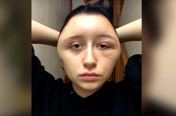 mujer desfigurada por alergia al tinte 1