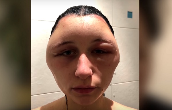 mujer desfigurada por alergia al tinte 2