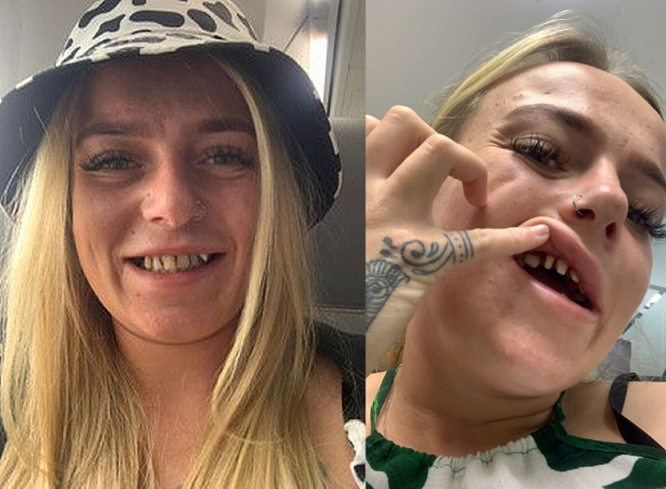 dientes antes y despues coronas