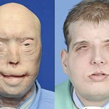 Muestran los impactantes resultados del trasplante de cara más completo de la historia