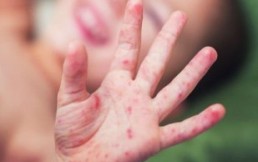 Enfermedad de manos, pies y boca: Síntomas del virus que afecta a los niños tras el aislamiento