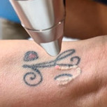 ¿Cuánto vale borrarse un tatuaje? Datos a tener en cuenta