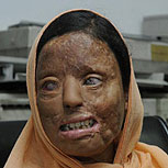 Mujer quemada con ácido pide morir: Brutal realidad en India