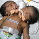 Bebé con dos cabezas en India: Impacto por raro caso médico