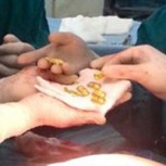 Cirujanos de India encuentran abundante oro en estómago de un paciente