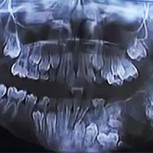 Dentista extrajo más de 80 dientes de la mandíbula de un niño en India
