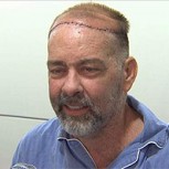 James Boysen: El exitoso primer trasplante de cráneo y cuero cabelludo del mundo