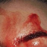 Mujer que transpira sangre tiene convulsionados a los médicos: ¿Cuál es la explicación?