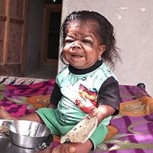 Extraña enfermedad mantiene a joven indio de 23 años como un bebé