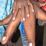 Niños de la India con manos gigantes: Extraños casos de malformaciones