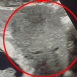 Descubren supuesto “fantasma” en ecografía de bebé