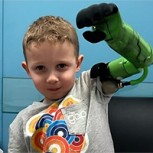 Pequeño de 5 años emociona al abrazar por primera vez a su hermano tras colocarse una prótesis inspirada en Hulk