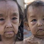 Dos niños impactan con el mismo mal que el personaje Benjamin Button