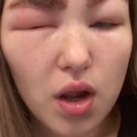 Tratamiento de belleza terminó con una peligrosa reacción alérgica que se hizo viral en TikTok