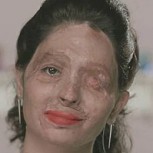 Impactante campaña de mujer desfigurada con ácido para detener estos ataques