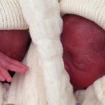 Bebés prematuras que lucharon por su vida y denuncia de negligencia médica estremecen a Coyhaique