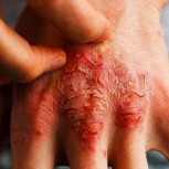Dermatitis atópica: Revisa los cuidados que debes tener con esta infección de la piel