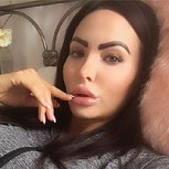 Popular youtuber inglesa se puso implantes y la experiencia fue traumática